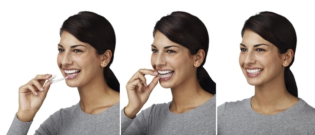 invisalign-header