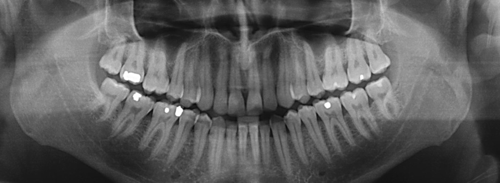 Dental-Xray-Image