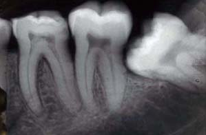 periapical-xray