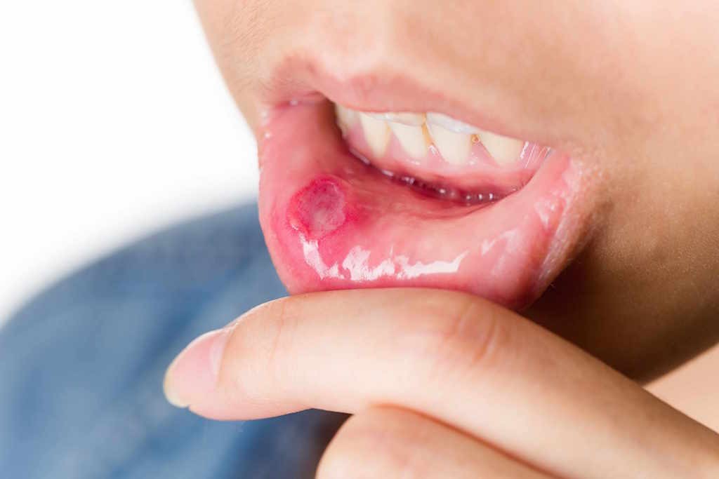 mouth-ulcer-1024x683